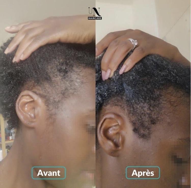 Antes después Cura para el crecimiento del cabello 1 mes